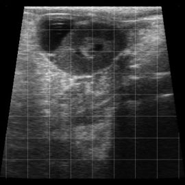 Corpus Luteum, Central Lacuna with Haemorrage and External Lacuna