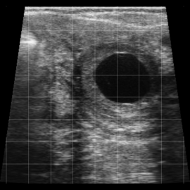 Luteal Cyst